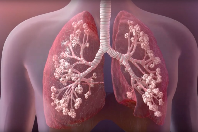 cystic fibrosis